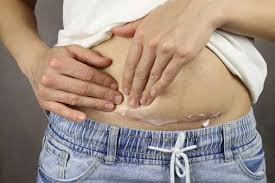 Professional C-Section Scar Care: Gentle Tissue Work